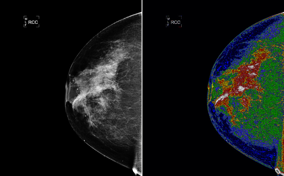 Октябрь - всемирный месяц борьбы против рака груди