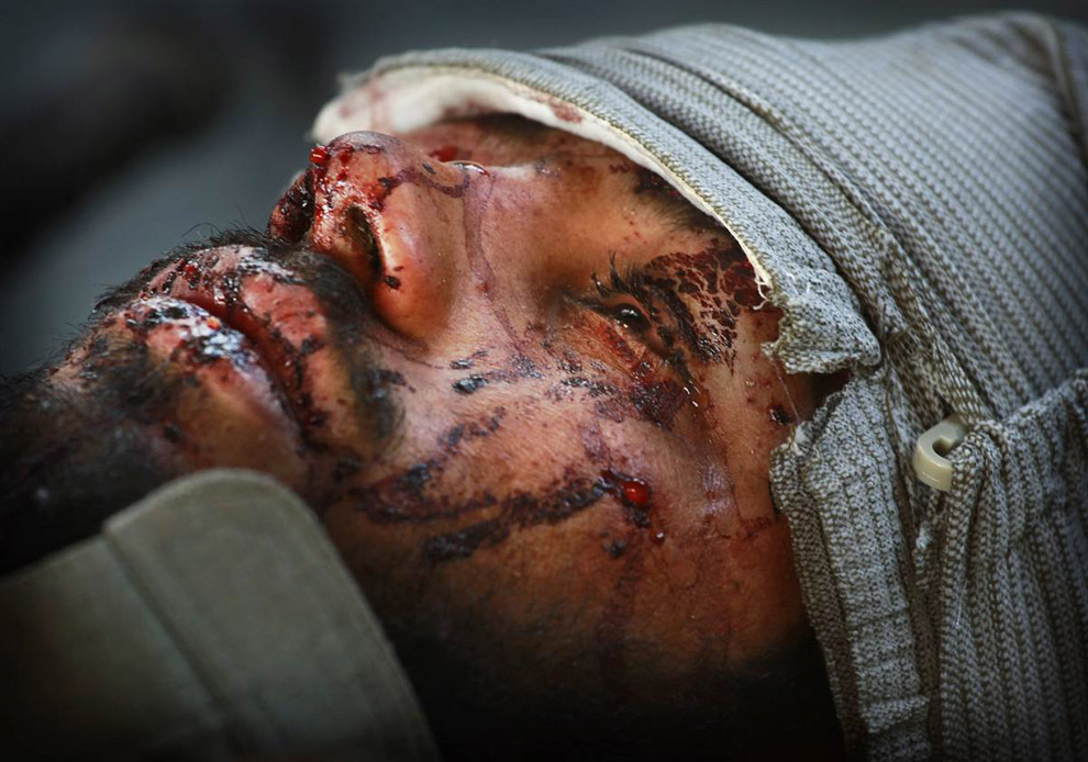Раненный афганец