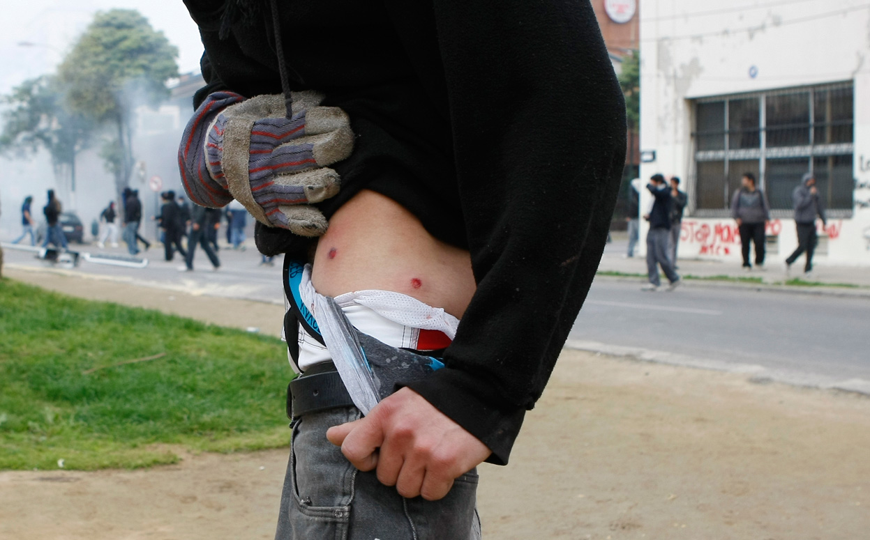 Раненный чилийский демонстрант