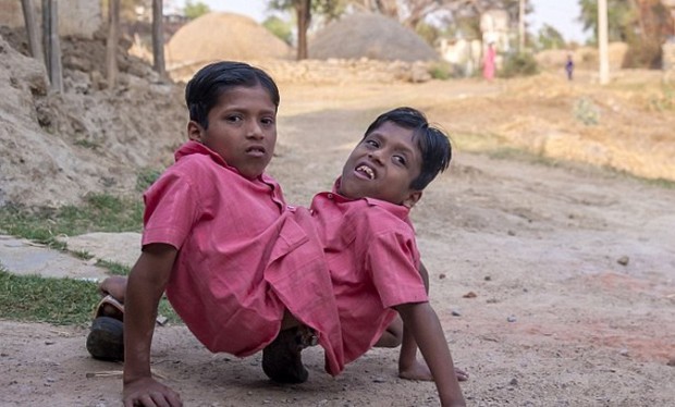 сиамские близнецы из Индии
