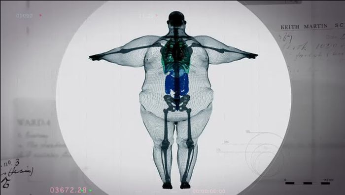 Рентген толстяка