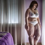 История девушки, похудевшей на более чем 50 килограммов благодаря шунтированию желудка